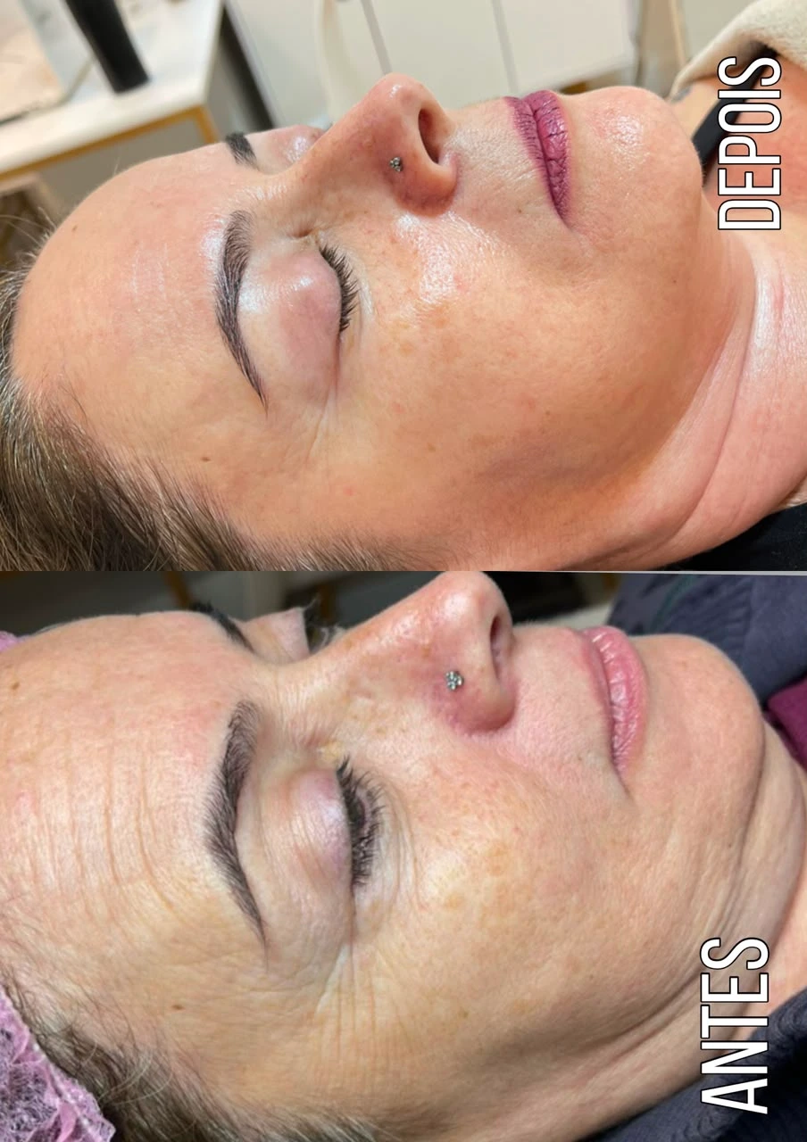 Antes e depois de um protocolo de ultrassom microfocado no rosto, resultado de cliente da clínica